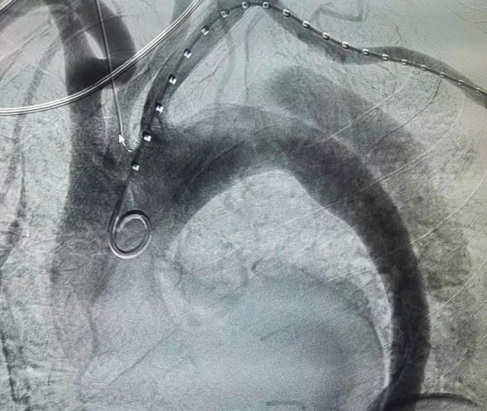 胸主动脉瘤介入支架图片